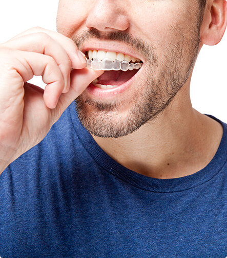 man inserting his clear aligners on his teeth