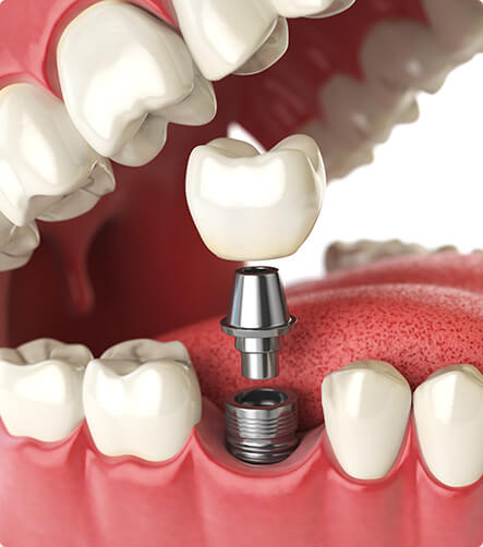 illustration of a dental implant