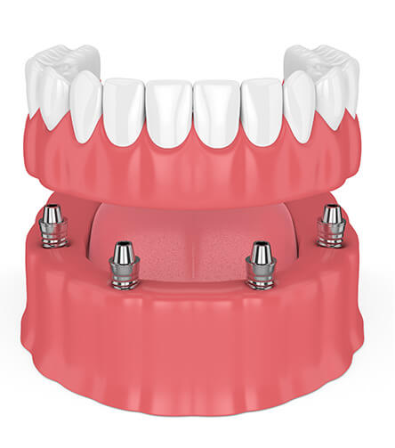 illustration of implant-supported dentures
