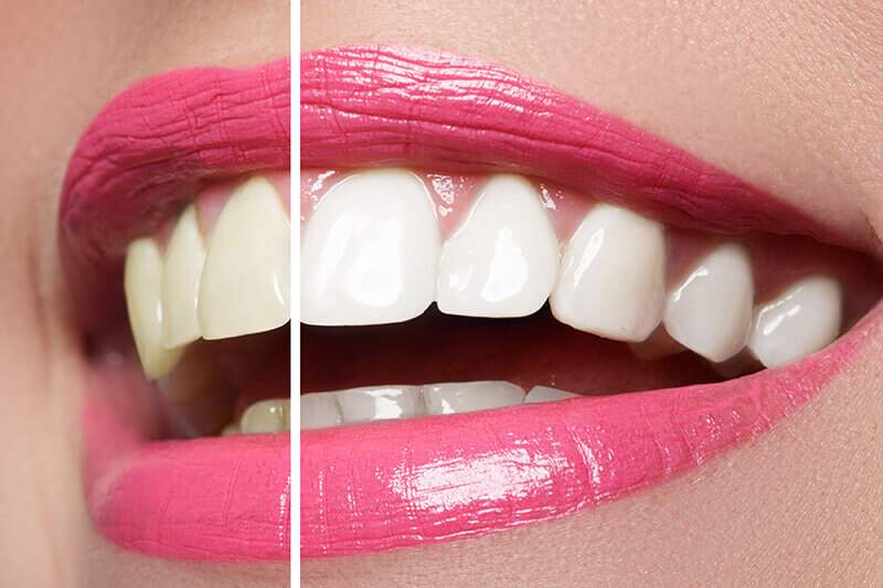 Teeth Whitening Dentistry Burleson, Keller, Uptown Dallas.