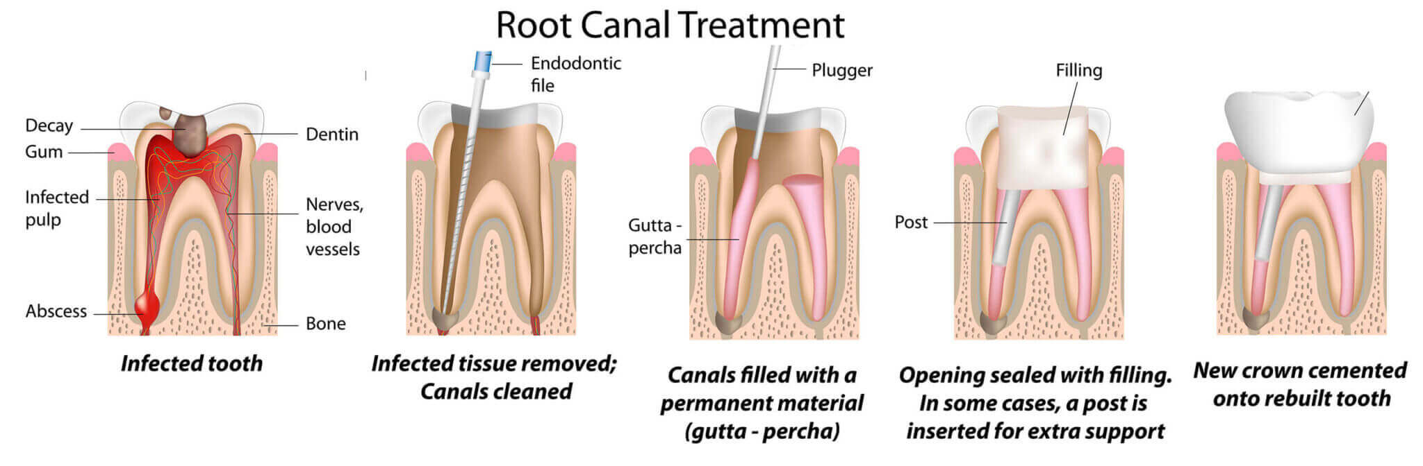 Root Canal Treatments in DFW