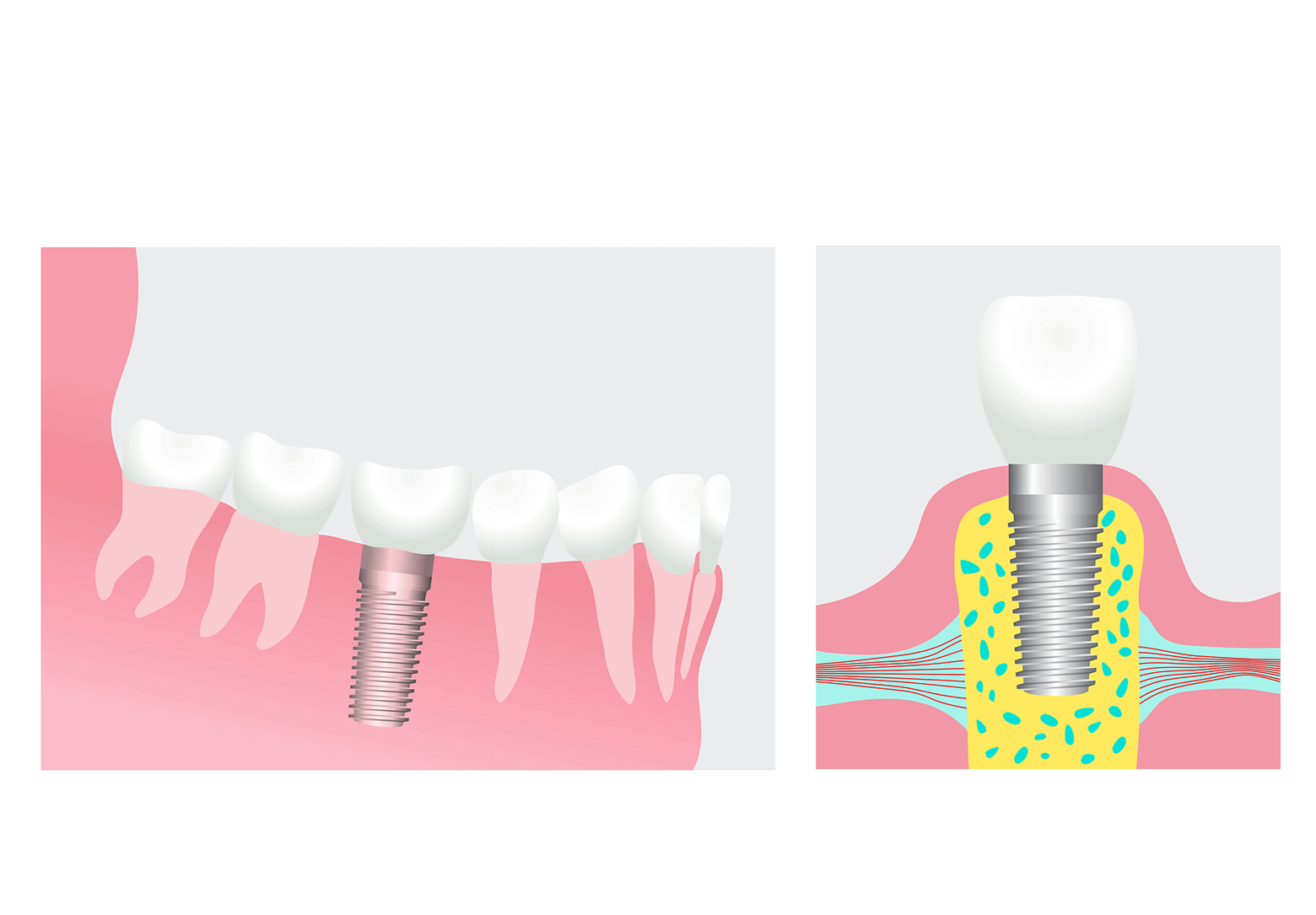 Dental Implant Illustration