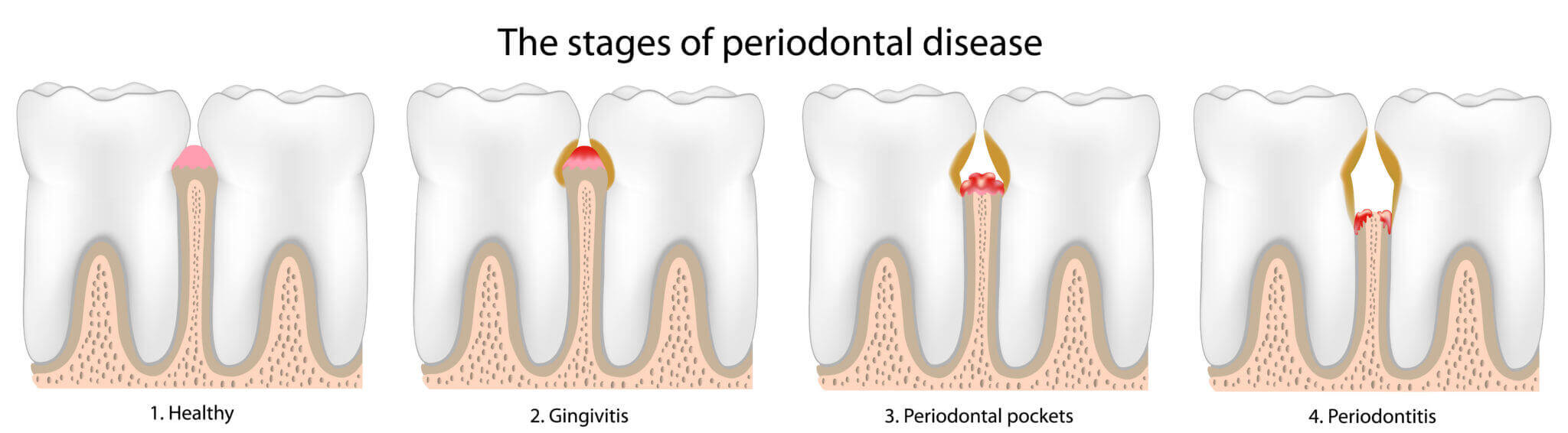 Periodontal Disease Graphic