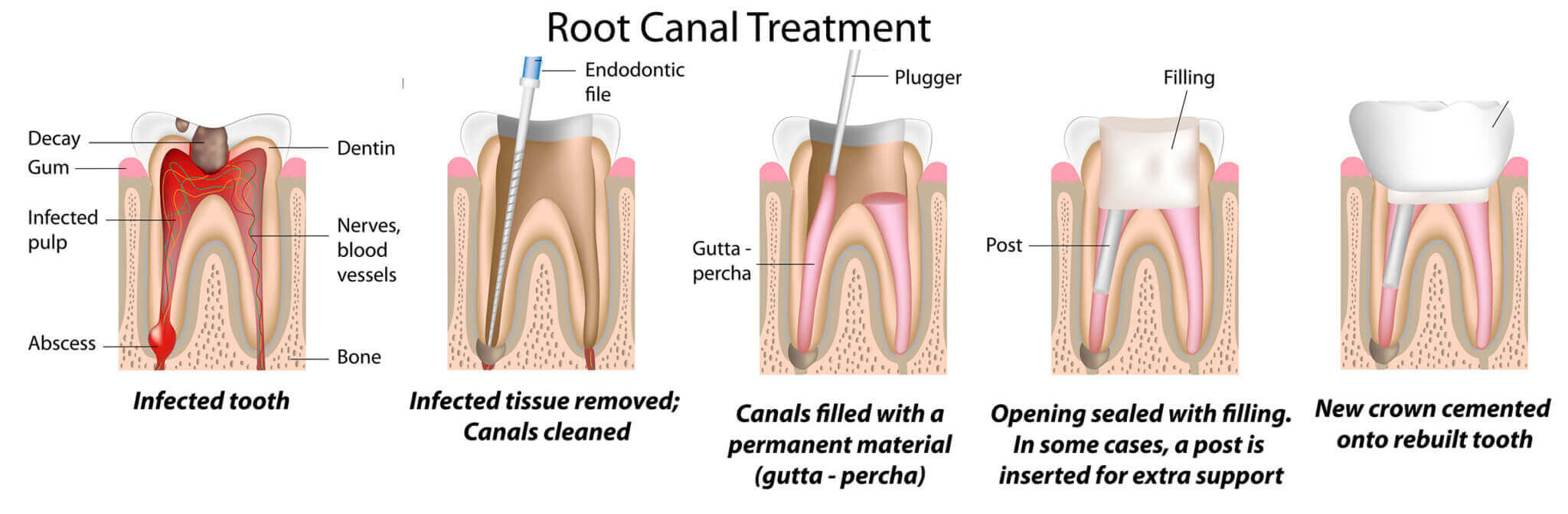 Root Canal Treatment Graphic