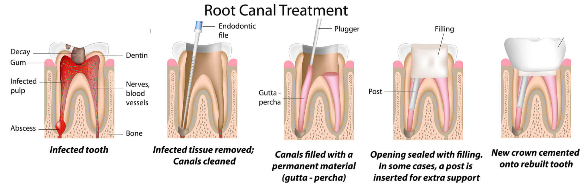 root canal aftercare instructions