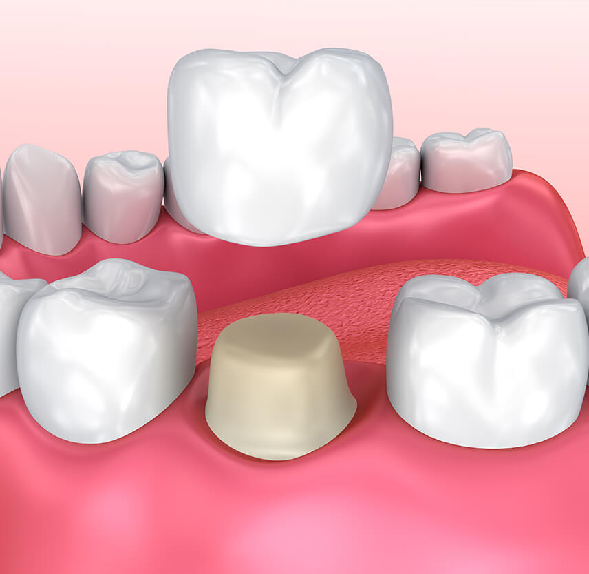 illustration of a dental crown
