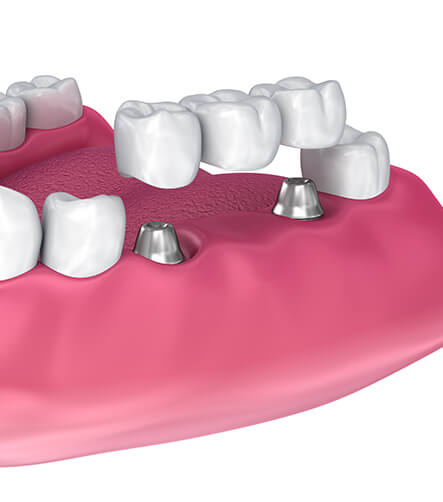 illustrative depiciton of a dental bridge