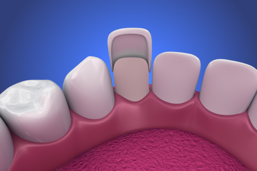 Model of a veneer placed on a smaller tooth.