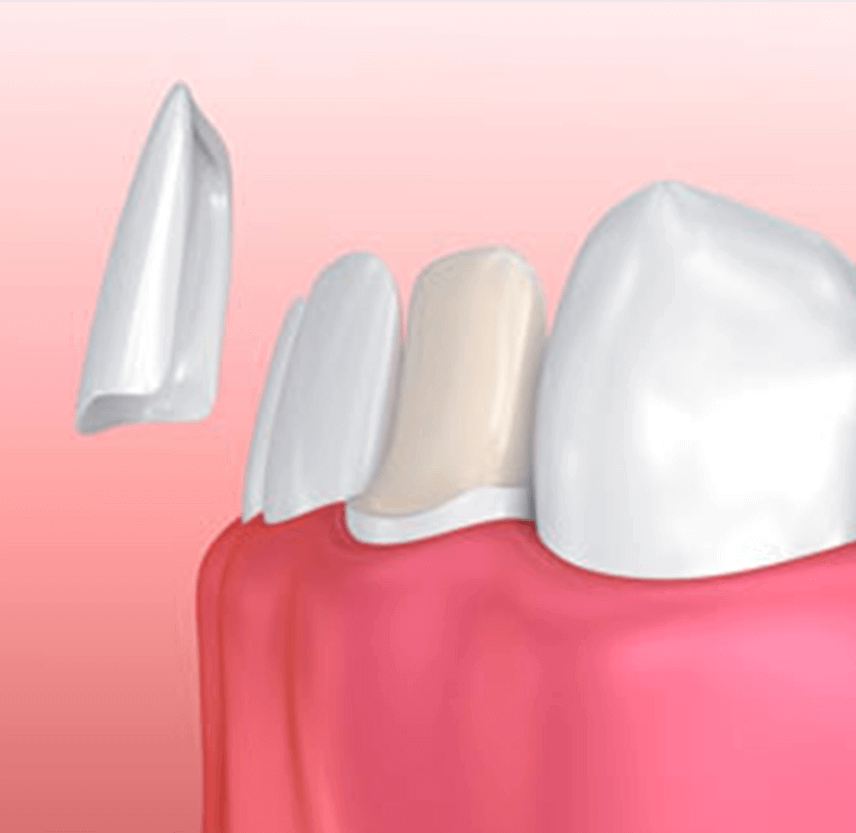 illustration of veneers