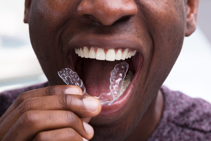 A man putting a clear aligner onto his teeth.