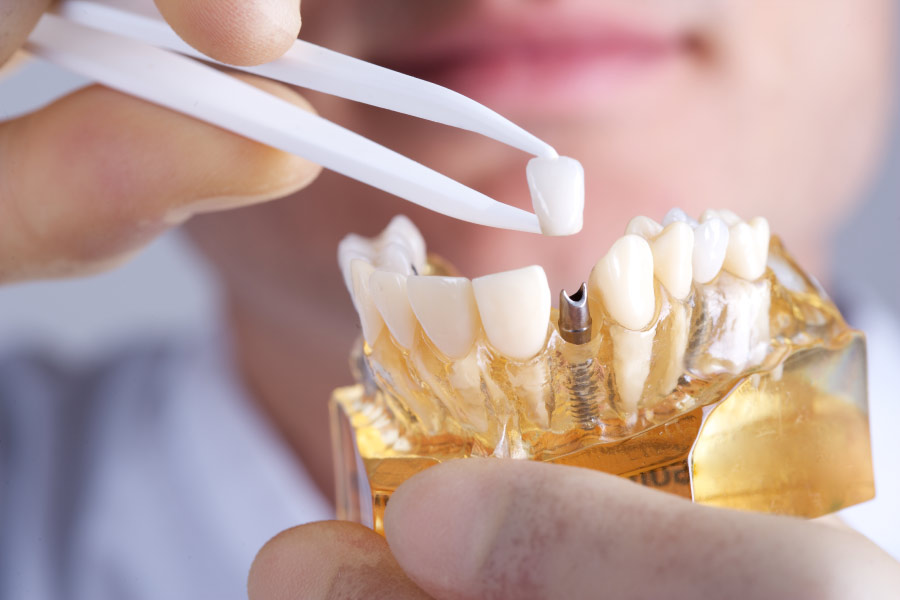 dentist showing a dental implant model